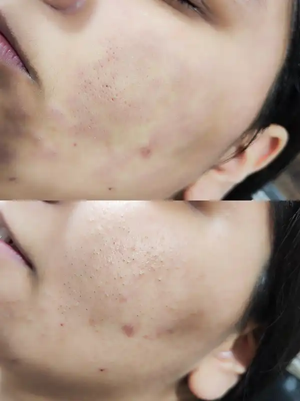 خدمات پوست - اپلاسیون - راضیه الهامیان