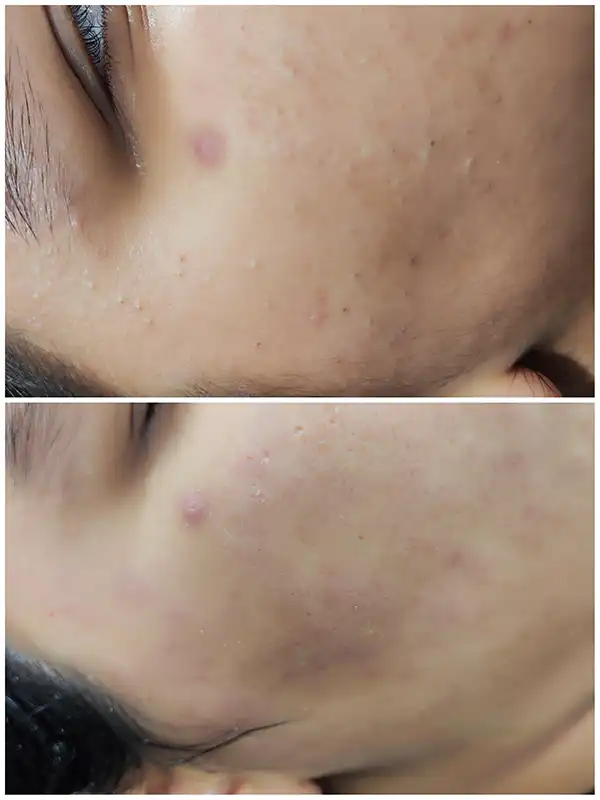 خدمات پوست - اپلاسیون - راضیه الهامیان