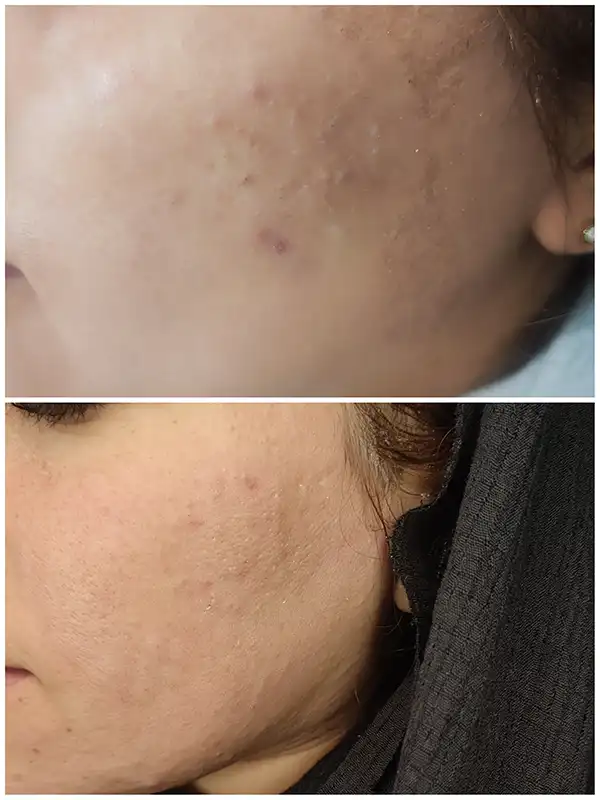 خدمات پوست - اپلاسیون - راضیه الهامیان